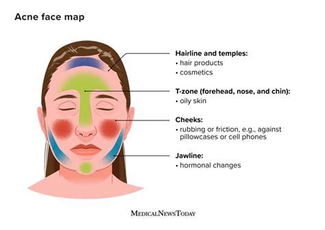What Causes Chin Acne