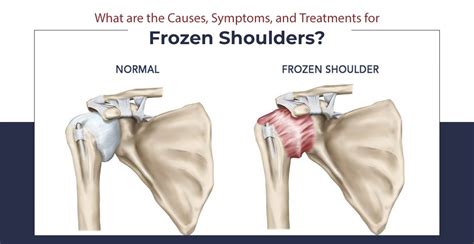 What Causes Frozen Shoulder