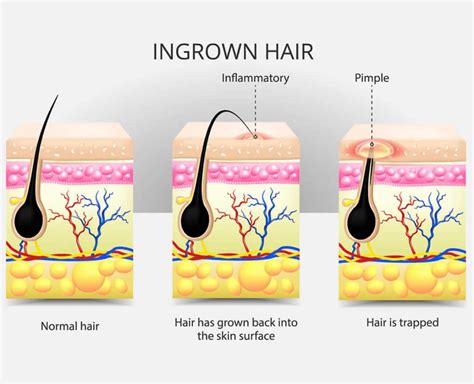What Causes Ingrown Hair