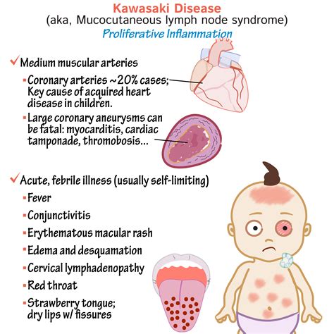 What Causes Kawasaki Disease