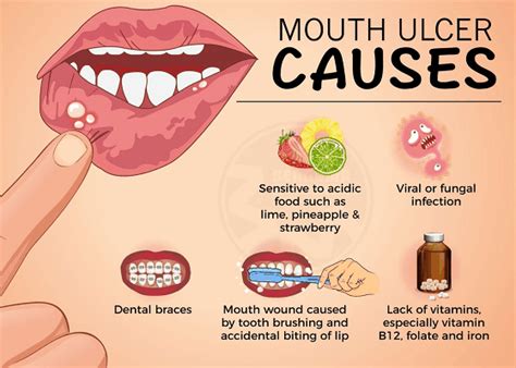 What Causes Mouth Ulcers