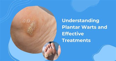 What Causes Plantar Warts