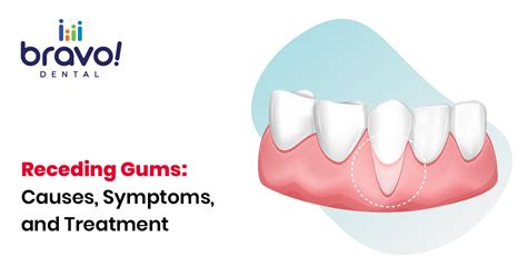 What Causes Receding Gums