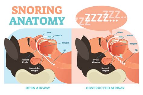 What Causes Snoring