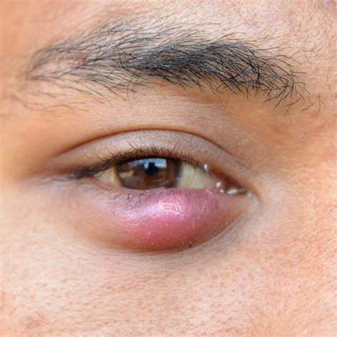 What Causes Styes In The Eye