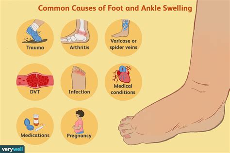 What Causes Swollen Ankles