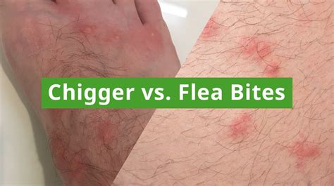 What Cures Chigger Bites