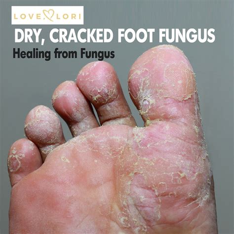What Cures Foot Fungus