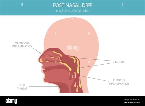 What Cures Post Nasal Drip