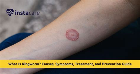 What Cures Ringworm On Human Skin