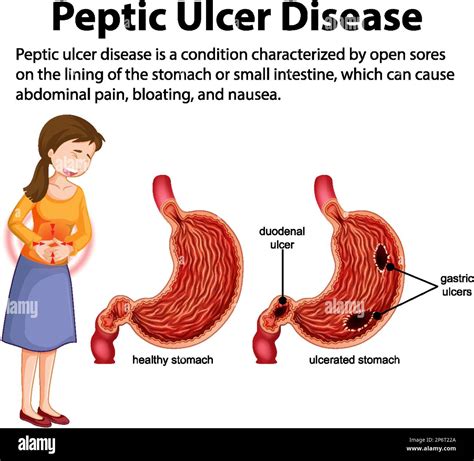 What Cures Ulcer Fastfood