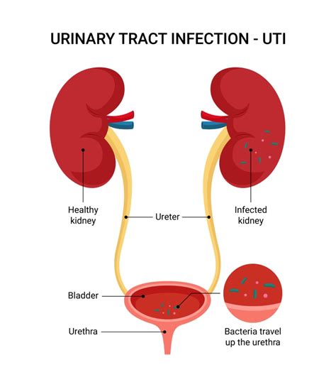 What Cures Urinary Tract Infection