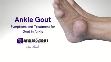 What Does Gout Feel Like Knee
