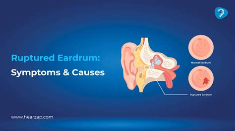 What Happens If Eardrum Ruptures