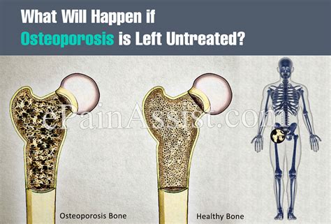 What Happens If Osteoporosis Is Untreated