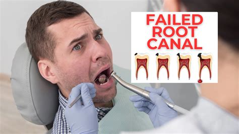 What Happens If Root Canal Fails