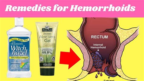 What Helps With Hemorrhoids