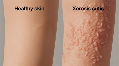 What Helps Xerosis