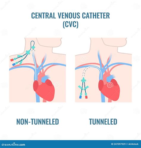 What Is A Central Line