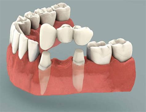 What Is A Dental Bridge