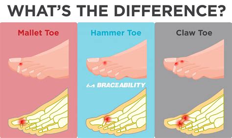 What Is A Hammer Toe