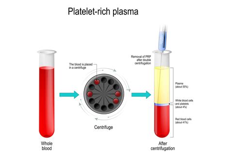 What Is A Prp Injection