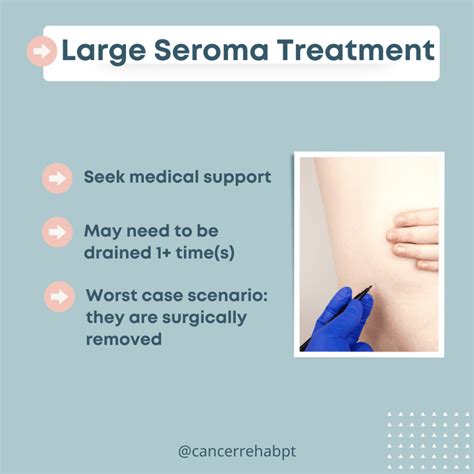 What Is A Seroma
