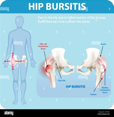What Is Bursitis Hip