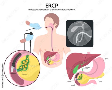 What Is Ercp