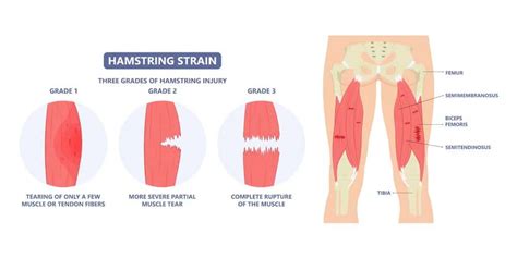What Is Hamstring Tear