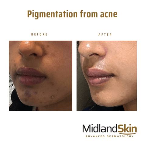 What Is Hyperpigmentation