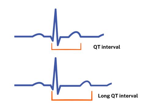 What Is Increased Qtc Interval