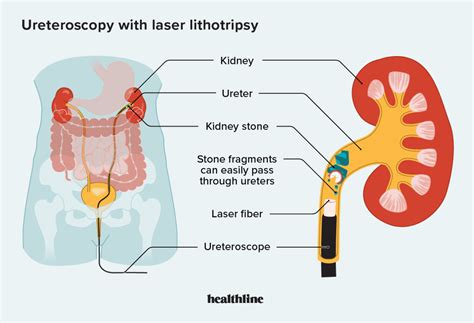 What Is Lithotripsy