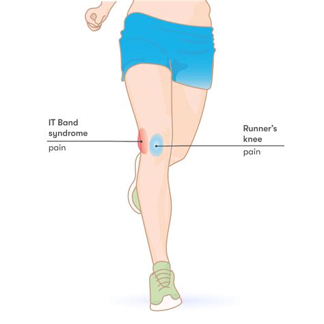 What Is Runners Knee