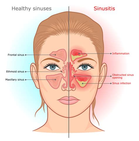 What Is Sinus Disease
