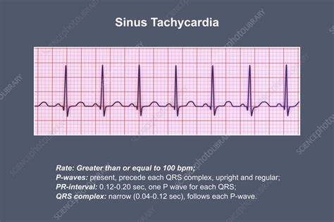 What Is Sinus Tachycardia