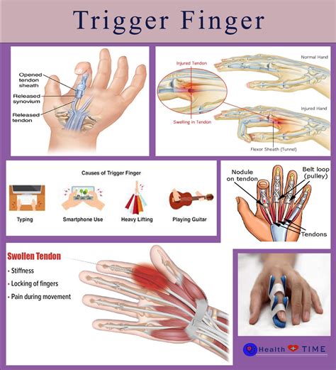 What Is Trigger Finger Symptoms