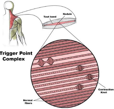 What Is Trigger Point Therapy
