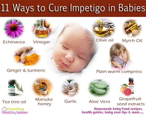 What Kills Impetigo Naturally