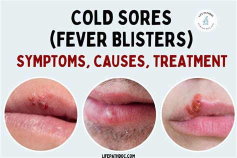 What Prevents Cold Sores