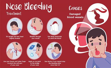 What Prevents Nose Bleeds