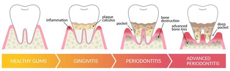 What Prevents Periodontal Disease