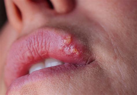 What Triggers Cold Sores On Lips