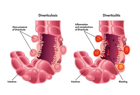 What Triggers Diverticular Bleeding