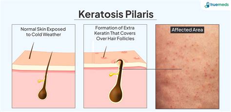 What Triggers Keratosis Pilaris