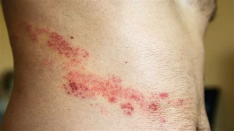 What Triggers Recurrent Shingles Outbreaks
