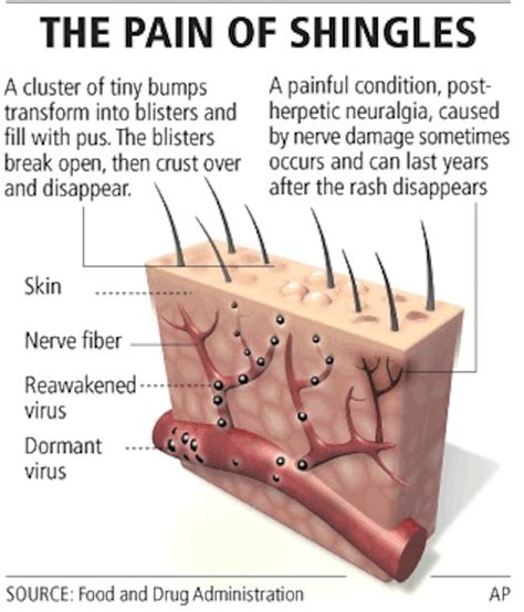 What Triggers Shingles In Adults