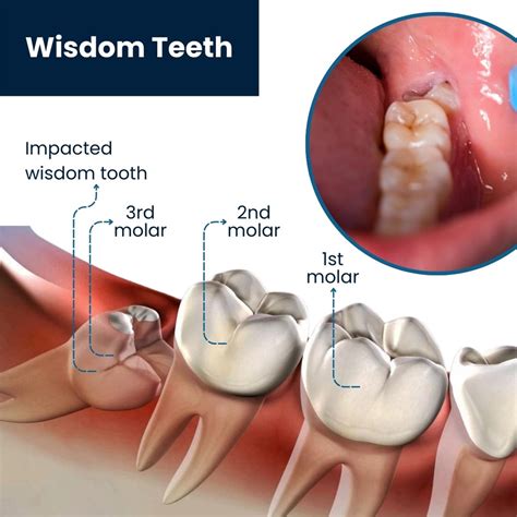 What Triggers Wisdom Tooth Pain