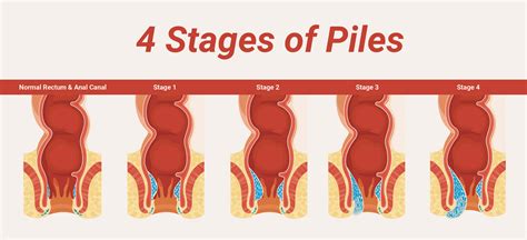 When Does Piles Happen