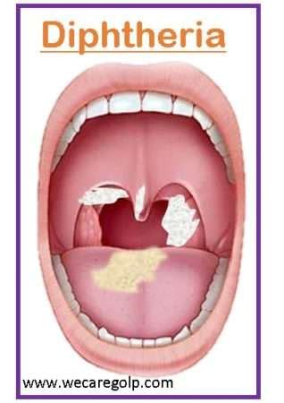 Where Is Diphtheria Found